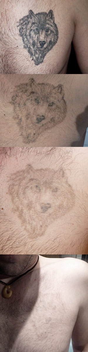 Tattoo removal
